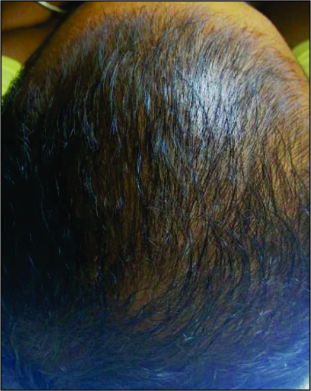 Hairfall-AFTER