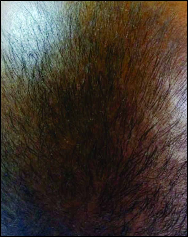 Hairfall-BEFORE
